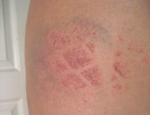 Fishnet Burn Sweet fishnet burn. That track hurts!